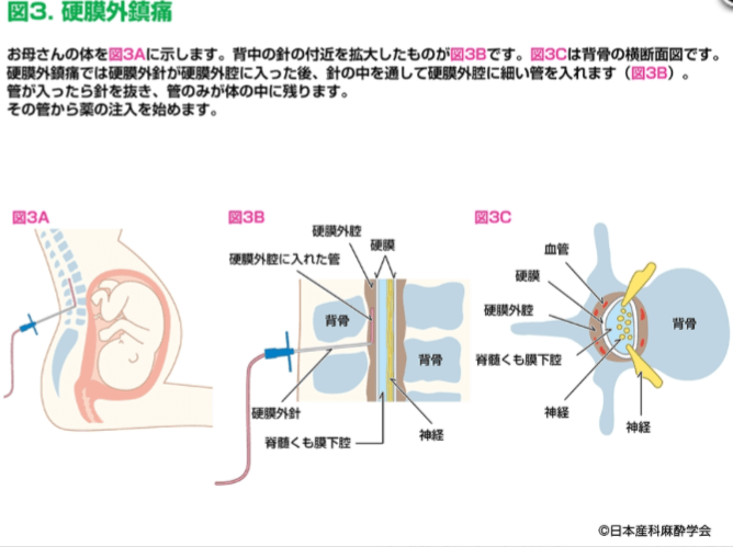 硬膜外腔の図
